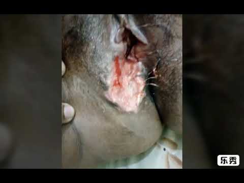 Successful treatment of infected surgical wound(post delivery) Video