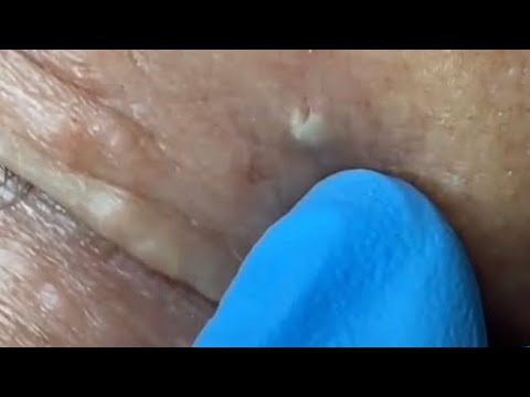 The blackheads around the eyes are removed. The face...
