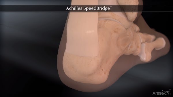 Arthrex SpeedBridge Video Thumbnail
