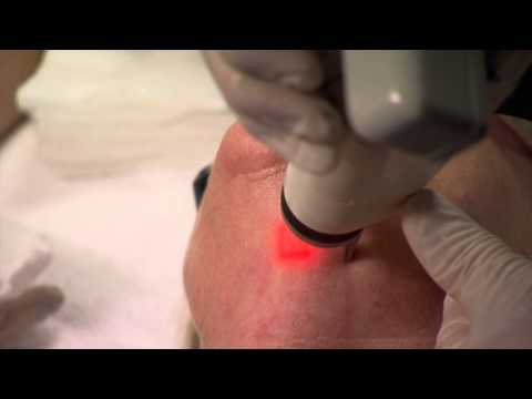 Neck Rejuvenation — Ultrapulse Fractional CO2 Laser Active FX — Laser Skin Care Australia