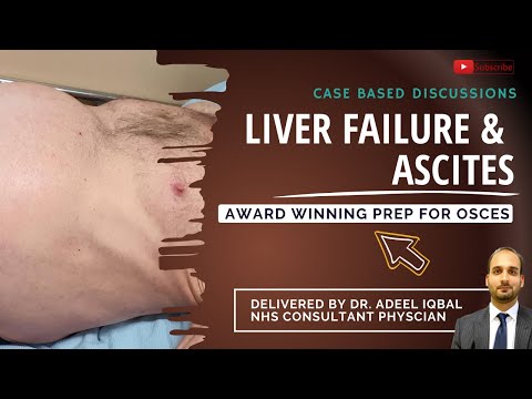 Liver Failure - Abdominal - BEST OSCE Preparation for Medical Student Exams