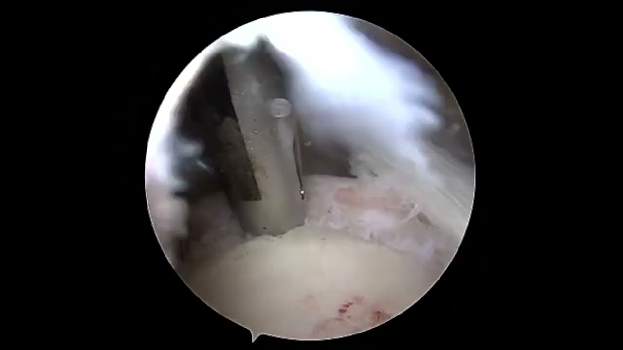 Complex Rotator Cuff Repair with Biceps Tendon Transfer