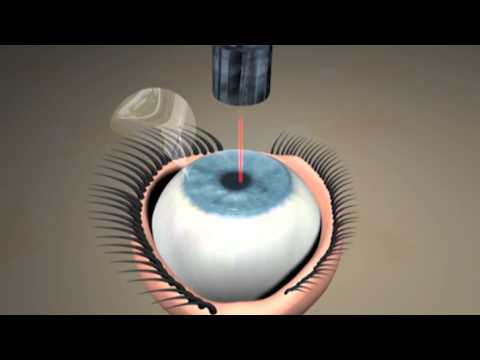 LASERSIGHT: LASIK Surgery - Gold Coast