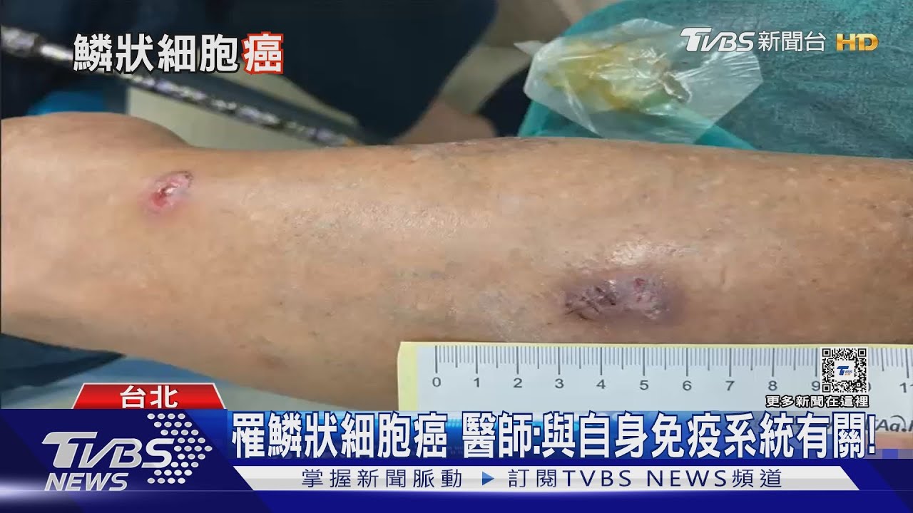 皮膚出現「這症狀」 醫師:太晚發現治療棘手、有致死風險!