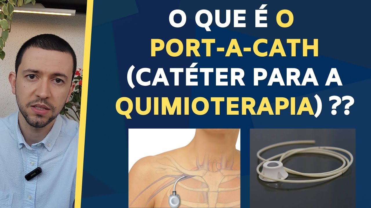O que é PORT-A-CATH (catéter para a QUIMIOTERAPIA)??