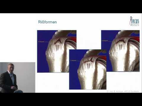 Fasten während joint disease ICD Joint Hämarthros Code