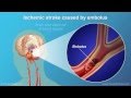 Understanding Stroke