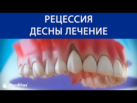 Pецессия десны лечение ©
