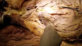 Download lagu INGUINAL CANAL Direct Indirect Hernia and 3-Piece Inflatable Urethral Implant – Sanjoy Sanyal mp3