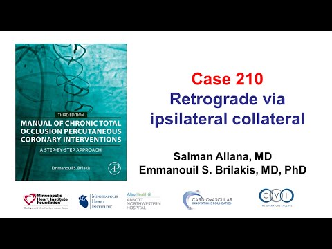 Case 210: Manual of CTO PCI - Retrograde via ipsilateral collateral