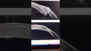 Download Lagu Severe keratoconus corneal transplant edge dehiscence, eyerubbing: resutureu0026 CXL: kanellopoulos, MD Thumbnail