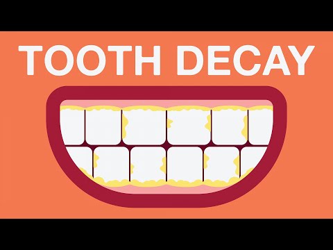 What causes tooth decay?