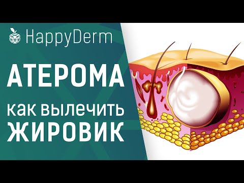 Атерома — что это такое, в чём отличие от липомы, опасен ли жировик на теле и как удалить атерому