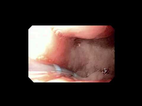 Diagnostic Gastro-Duodenoscopy Via A Gastro-Gastric Fistula Prior To Overstitch Closure