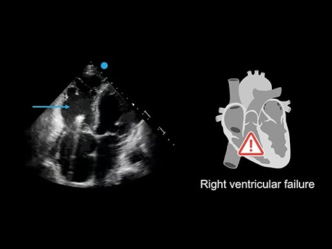 Recognizing poor right ventricular systolic function in echocardiography