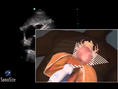 How To: EFAST - Subxiphoid View 3D Video