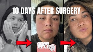 What Wisdom Teeth Recovery Is Really Like | Day 1–10 + 5 Weeks Later