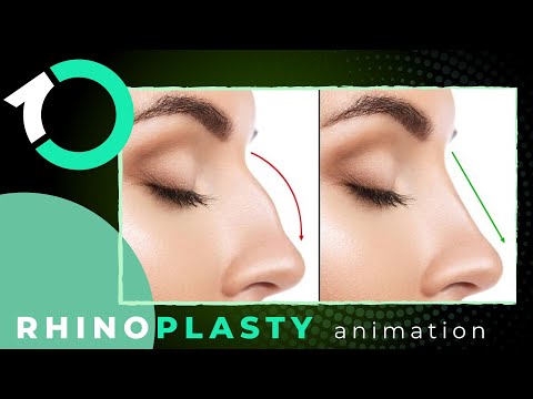 Ultrasonic Piezo Rhinoplasty - Surgical Procedure - One Clinic Patient Review Video