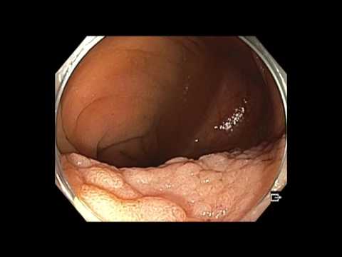 Colonoscopy: IC valve and cecum flat lesion - too large lesion to resect