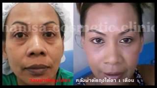 ผ่าตัดถุงใต้ตา