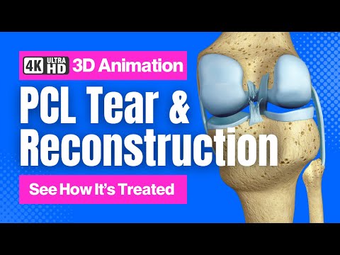See how Surgeons fix PCL Tears - Patellar vs. Hamstring Graft Techniques - 4K 3D Animation