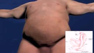 Intervento di bypass gastrico 🏥