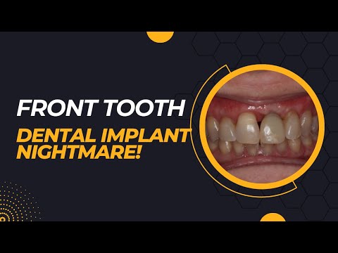 Front Tooth Dental Implant Gone Wrong. Bone Graft or Gum Graft?  