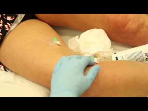 BAS Sclerotherapy compilation