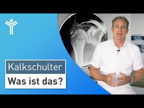 Calcified shoulder simply explained: This is how shoulder pain is caused by calcified shoulder