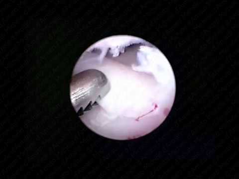 La rimozione del dolore acuto nella osteocondrosi cervicale Alimentando il mal di schiena