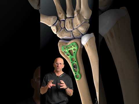 Distal Radius 🪛 Plate and Screws #shorts