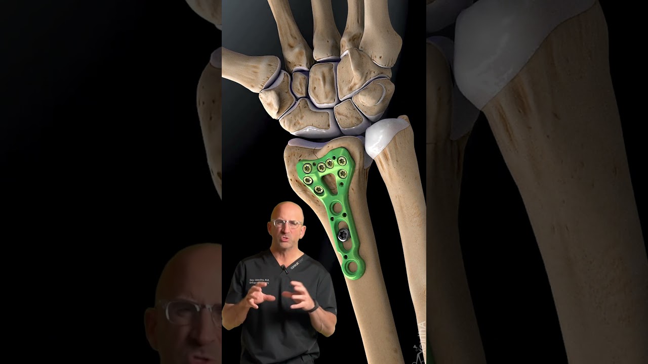 Distal Radius 🪛 Plate and Screws #shorts