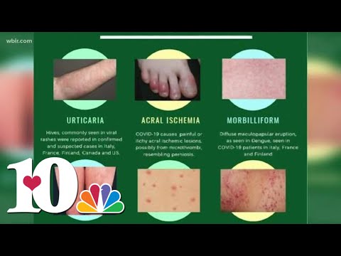 Doctor: Skin rash could be a symptom as possible COVID-19 symptom