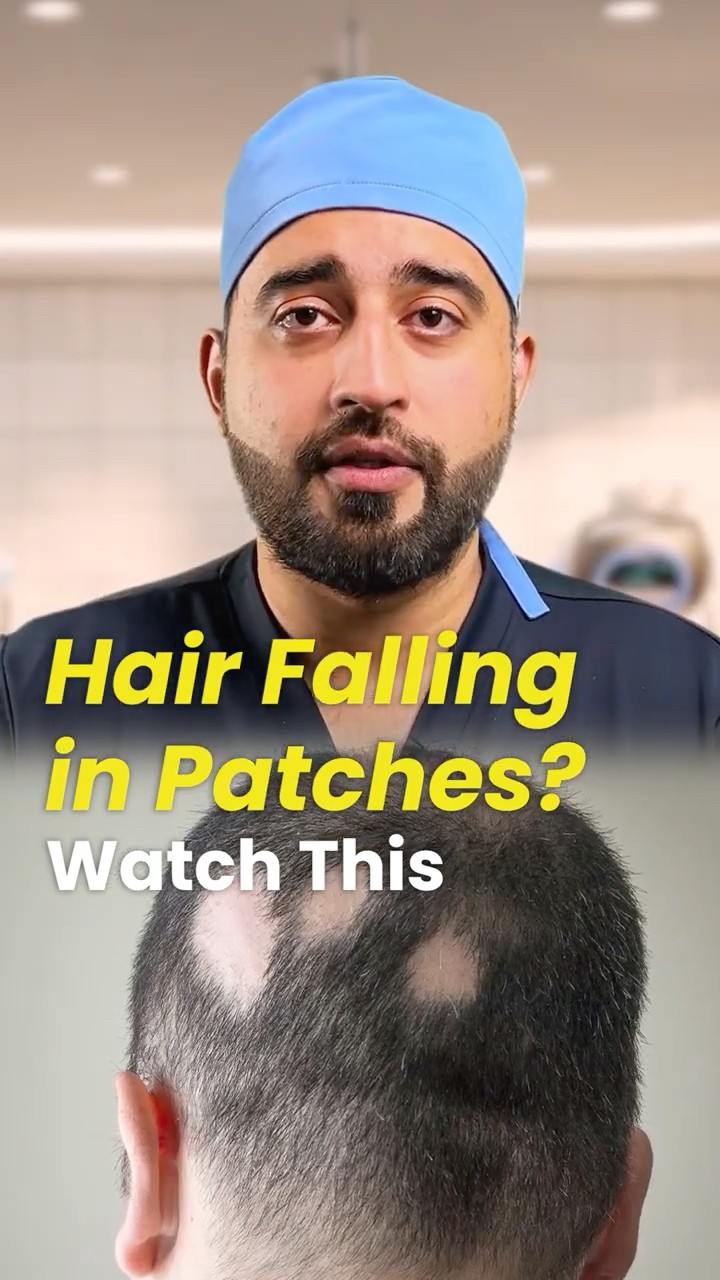 Alopecia areata