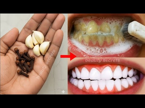 The secret that dentists don't want you to know: whitens teeth in 1 minute and removes tartar.