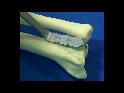UHP | Ulnar Head Prosthesis