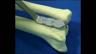 UHP | Ulnar Head Prosthesis