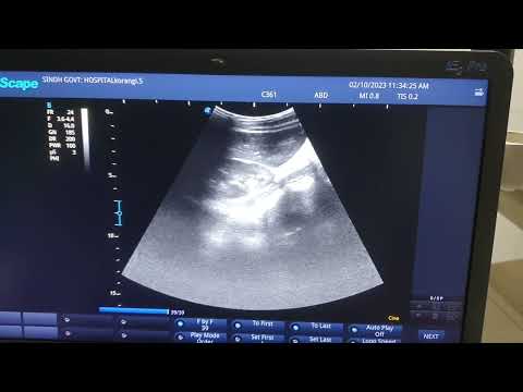 Urinary Bladder Stone 3.2 cm . 9 yrs old male Child