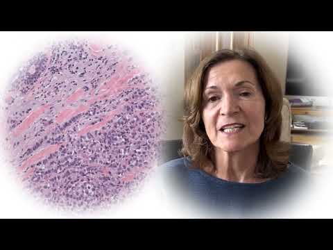 What Is Lobular Breast Cancer and What is LBCA?