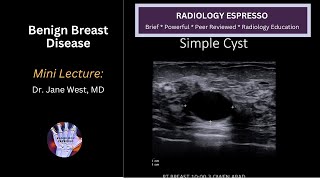 BENIGN BREAST DISEASE: Mini Lecture, Dr. Jane West, MD