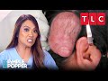 Life-Changing Pops | Dr. Pimple Popper | TLC