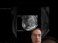 A baby tumour bigger than the baby!