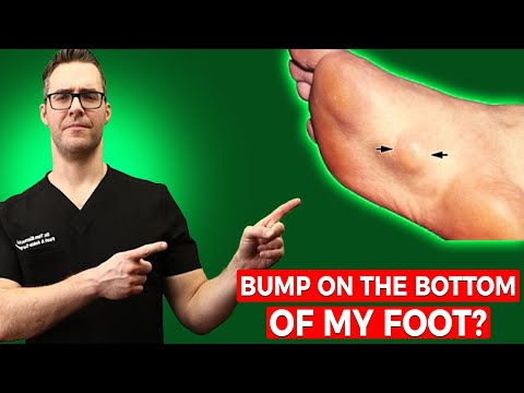 Bump on the Bottom of My Foot? [Plantar Fibroma Treatment & Massage!]