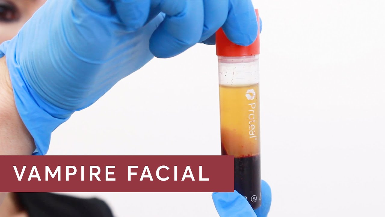 Vampire Facial - What does platelet-rich plasma (PRP) do ?