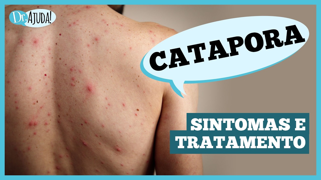 CATAPORA pode ser grave? E o que tem a ver com HERPES-ZÓSTER? #catapora #herpeszoster