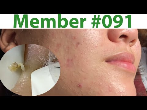 Acne Treatment Huong Da Nang# 091 ) Member