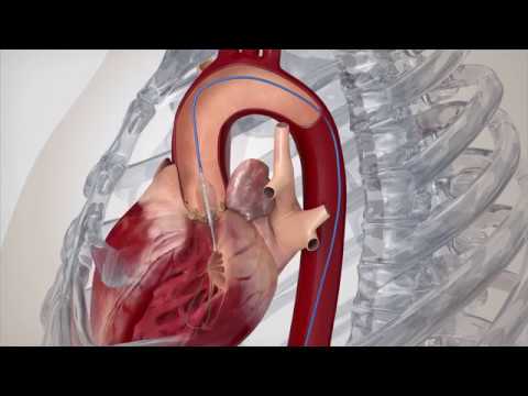 TAVR SAPIEN 3 TF Procedure Animation