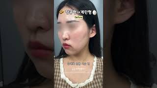 땅콩형 얼굴 시술