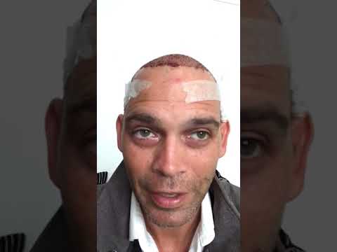 Worth a watch Hair Transplant Patient just arrived home from the clinic.