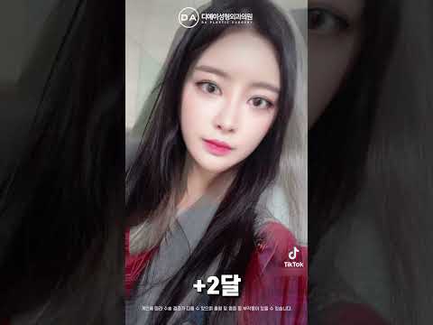 미니리프팅+코재수술+매몰